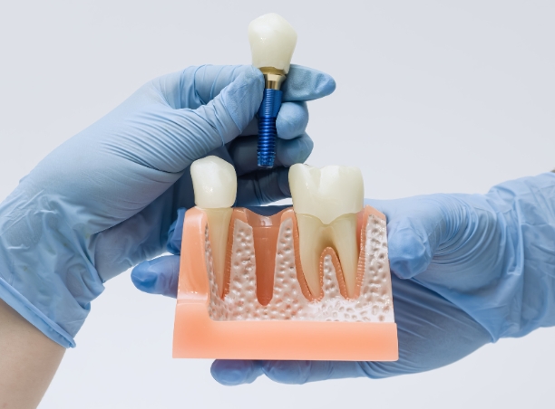 Implant dentar la Atelierul de Zâmbete, Sector 3 București