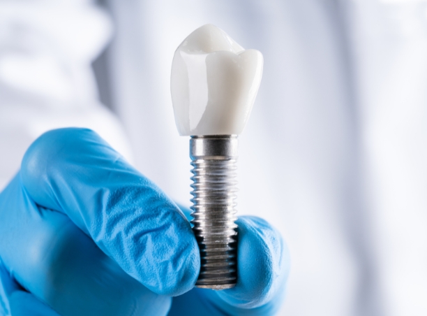 Coroană pe implant dentar realizată la Atelierul de Zâmbete