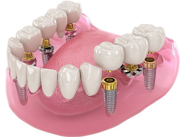 Implant dentar cu planificare digitală la Atelierul de Zâmbete